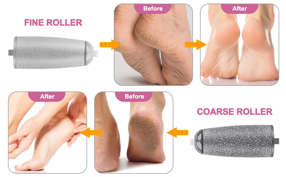 Callus remover